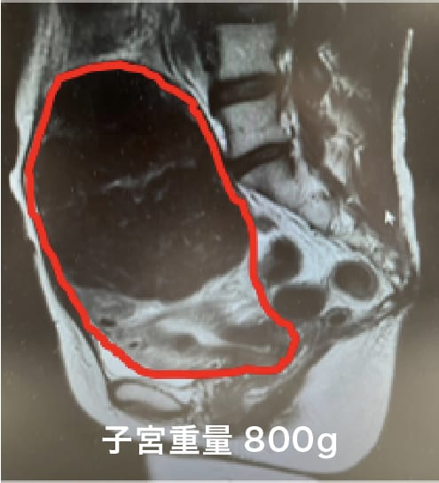 慈恵医大産婦人科の手術